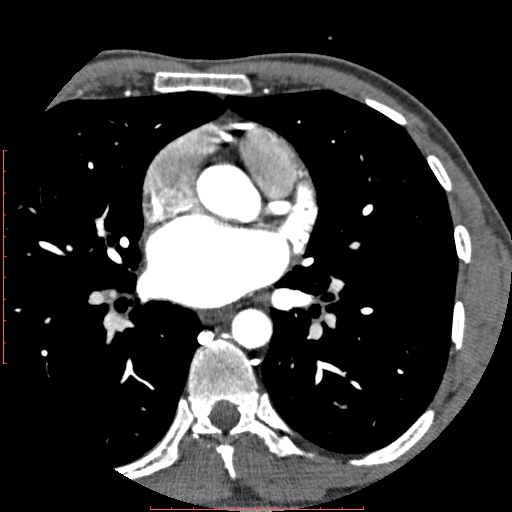 File:Anomalous left coronary artery from the pulmonary artery (ALCAPA) (Radiopaedia 70148-80181 A 107).jpg