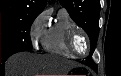 Anomalous left coronary artery from the pulmonary artery (ALCAPA) (Radiopaedia 70148-80181 B 82).jpg