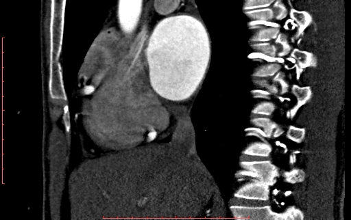 Anomalous left coronary artery from the pulmonary artery (ALCAPA) (Radiopaedia 70148-80181 C 71).jpg
