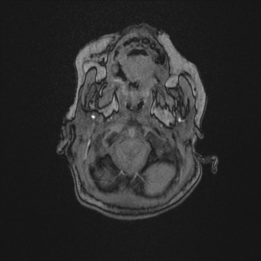 Anoxic brain injury (Radiopaedia 79165-92139 Axial MRA 19).jpg