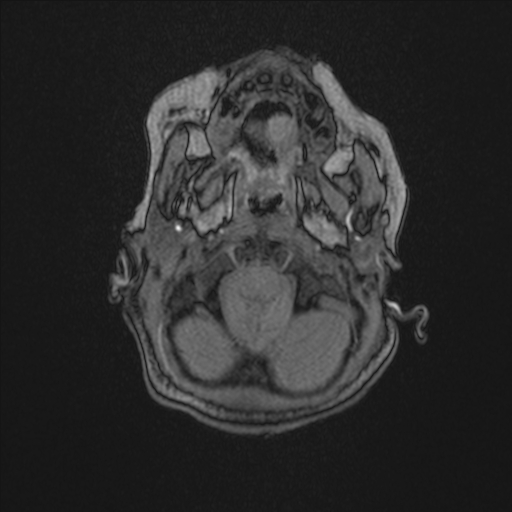 Anoxic brain injury (Radiopaedia 79165-92139 Axial MRA 23).jpg
