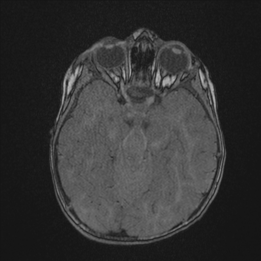 File:Anoxic brain injury (Radiopaedia 79165-92139 Axial MRA 84).jpg