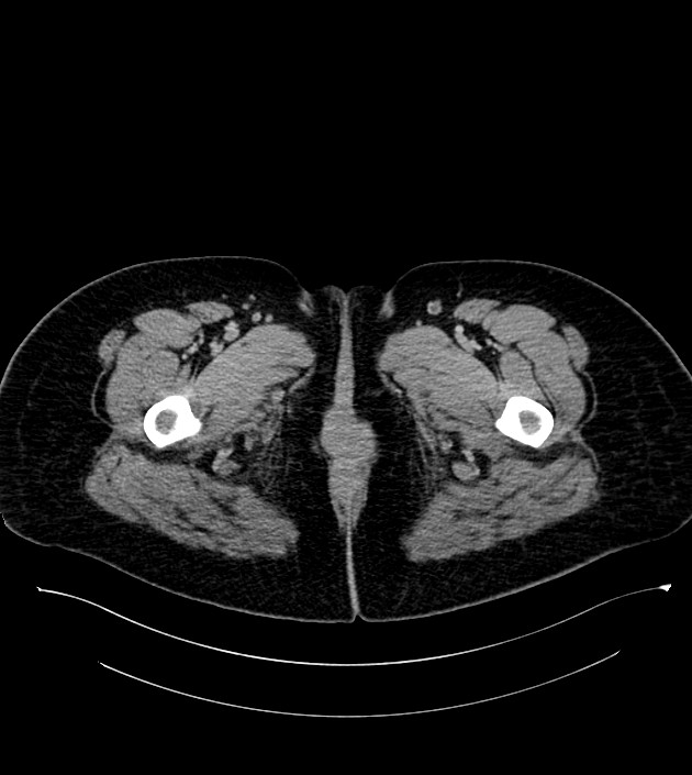 Anterior abdominal wall CSF pseudocyst (CSFoma) (Radiopaedia 79453-92571 A 101).jpg