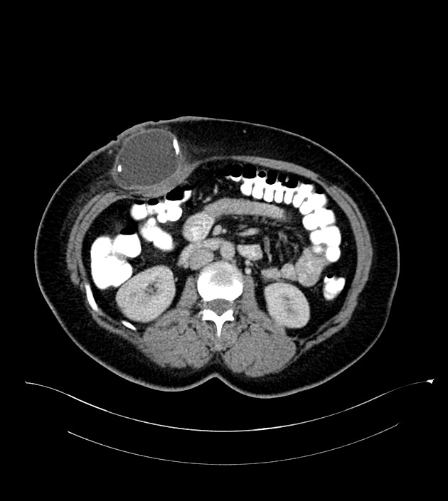 Anterior abdominal wall CSF pseudocyst (CSFoma) (Radiopaedia 79453-92571 A 44).jpg