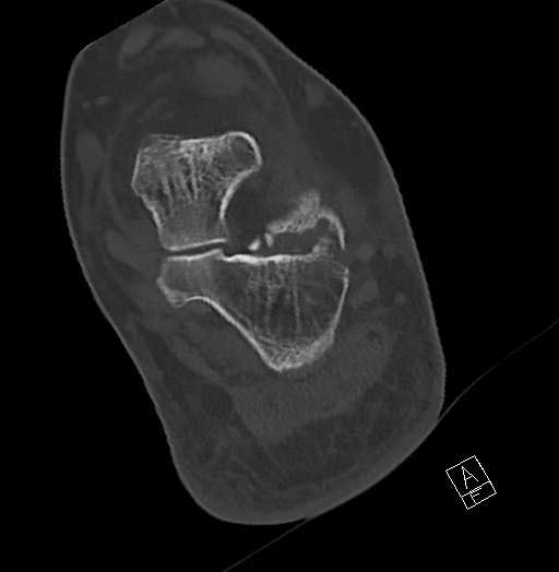 Anterior calcaneal process fracture (Radiopaedia 63353-71943 Axial bone window 98).jpg