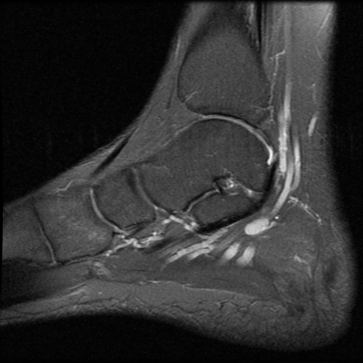 File:Anterior calcaneal process fracture (Radiopaedia 74654-85611 Sagittal PD fat sat 6).jpg