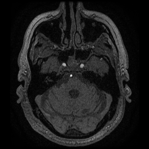 Anterior cerebral artery infarction (Radiopaedia 46794-51323 Axial MRA 32).jpg