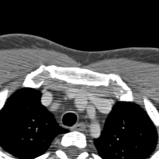 File:Anterior cerebral artery territory infarct (Radiopaedia 39327-41581 B 107).png