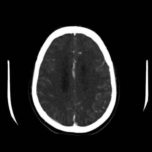 File:Anterior communicating artery aneurysm (Radiopaedia 16633-16335 A 32).jpg