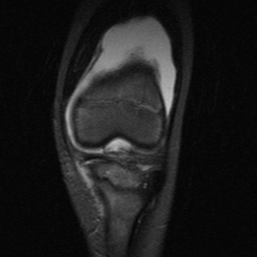 File:Anterior cruciate ligament avulsion fracture (Radiopaedia 24710-24974 Coronal STIR 4).jpg