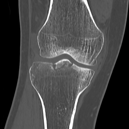 File:Anterior cruciate ligament avulsion fracture (Radiopaedia 58939-66194 Coronal bone window 13).jpg