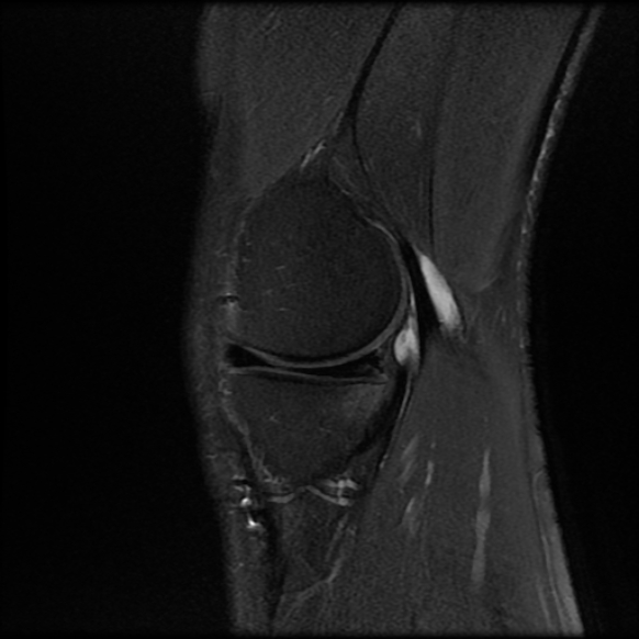 File:Anterior cruciate ligament graft tear and bucket-handle tear of medial meniscus (Radiopaedia 75867-87254 Sagittal PD fat sat 7).jpg