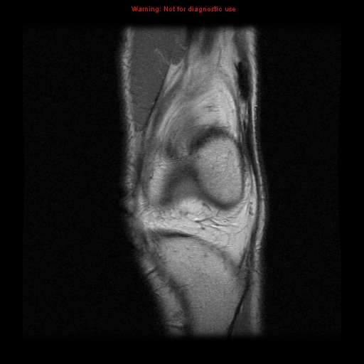 File:Anterior cruciate ligament injury - partial thickness tear (Radiopaedia 12176-12515 Coronal PD 4).jpg