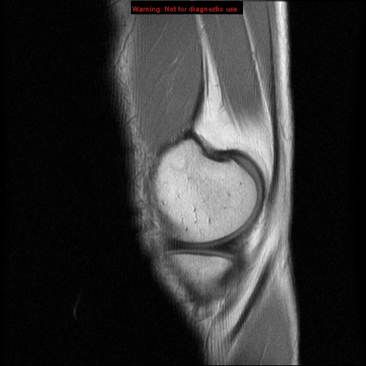 File:Anterior cruciate ligament injury - partial thickness tear (Radiopaedia 12176-12515 Sagittal PD 3).jpg