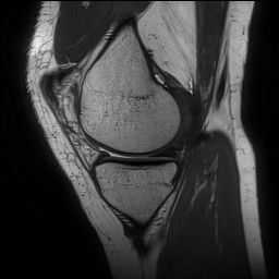 Anterior cruciate ligament rupture and posteromedial corner injury (Radiopaedia 67338-76723 Sagittal PD 54).jpg