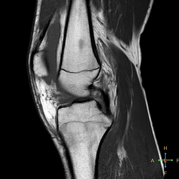 File:Anterior cruciate ligament tear - complete (Radiopaedia 24907-25170 Sagittal T1 10).jpg