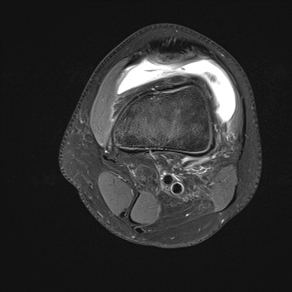 File:Anterior cruciate ligament tear - pediatric (Radiopaedia 62152-70260 Axial PD fat sat 6).jpg