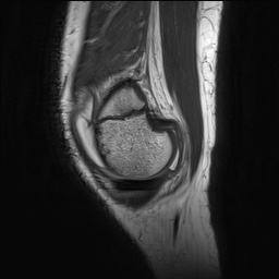Anterior cruciate ligament tear - pediatric (Radiopaedia 62152-70260 Sagittal PD 32).jpg