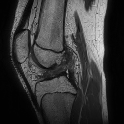 Anterior cruciate ligament tear - pediatric (Radiopaedia 62152-70260 Sagittal PD 92).jpg