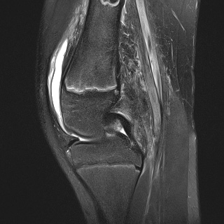 File:Anterior cruciate ligament tear - pediatric (Radiopaedia 62152-70260 Sagittal PD fat sat 16).jpg