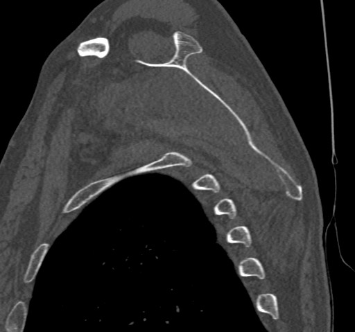 File:Anterior glenohumeral dislocation with Hill-Sachs lesion (Radiopaedia 62877-71249 Sagittal bone window 46).jpg