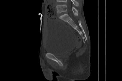 Anterior inferior iliac spine avulsion injury (Radiopaedia 88666-105376 Sagittal bone window 48).jpg