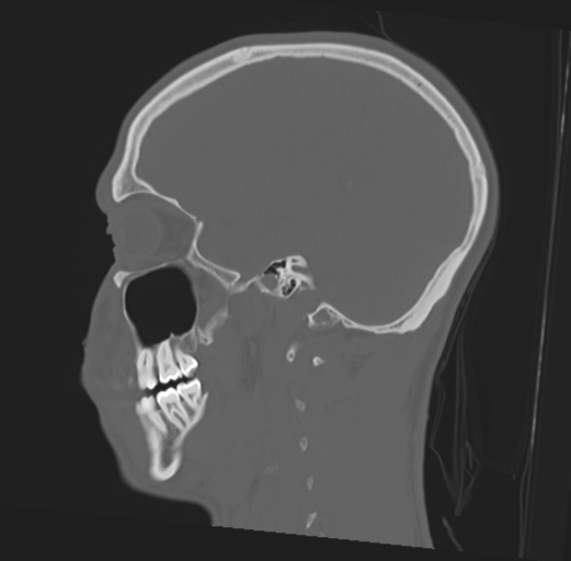 Anterior nasal spine fracture (Radiopaedia 46138-50494 Sagittal bone window 38).png