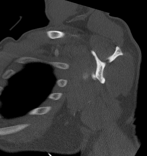 Anterior shoulder dislocation with Hill-Sachs and bony Bankart lesions (Radiopaedia 40424-42974 Sagittal bone window 32).png