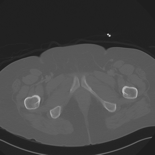 Anterior superior iliac spine avulsion fracture (Radiopaedia 44541-48244 Axial bone window 104).png