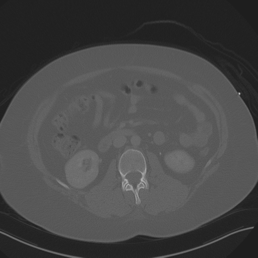 File:Anterior superior iliac spine avulsion fracture (Radiopaedia 44541-48244 Axial bone window 45).png