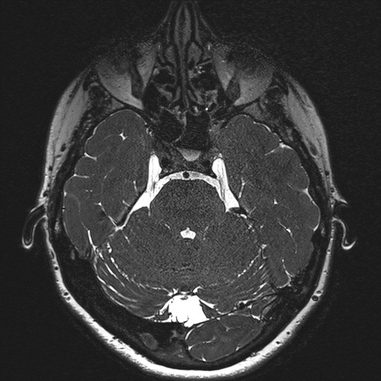 Anterior temporal encephalocele (Radiopaedia 82624-96808 Axial T2 high res 44).jpg