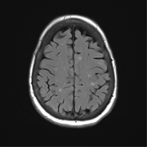 File:Anterior temporal pole cysts (Radiopaedia 46629-51102 Axial FLAIR 21).png