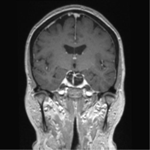 Anterior temporal pole cysts (Radiopaedia 46629-51102 Coronal T1 C+ 93).png