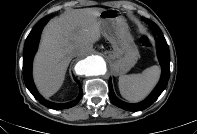 File:Anterior vertebral scalloping (abdominal aortic aneurysm) (Radiopaedia 66744-76067 F 2).jpg