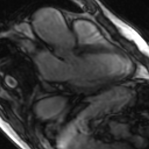 File:Anteroseptal hypokinesia after myocardial infarction (Radiopaedia 15978-15633 3 chamber view SSFE 16).jpg