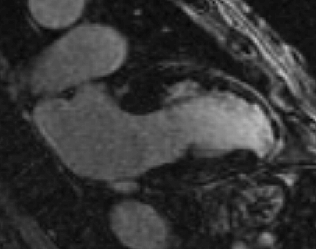 File:Anteroseptal hypokinesia after myocardial infarction (Radiopaedia 15978-15633 F 1).jpg