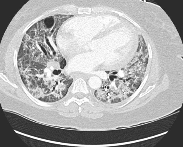 Anti-synthetase syndrome (anti-Jo1) (Radiopaedia 31899-32846 Axial lung window 38).JPG