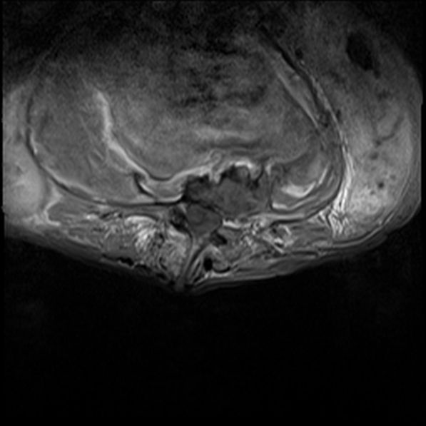 File:Aortic aneurysm with spinal destruction (Radiopaedia 42301-45409 Axial T1 fat sat 19).jpg