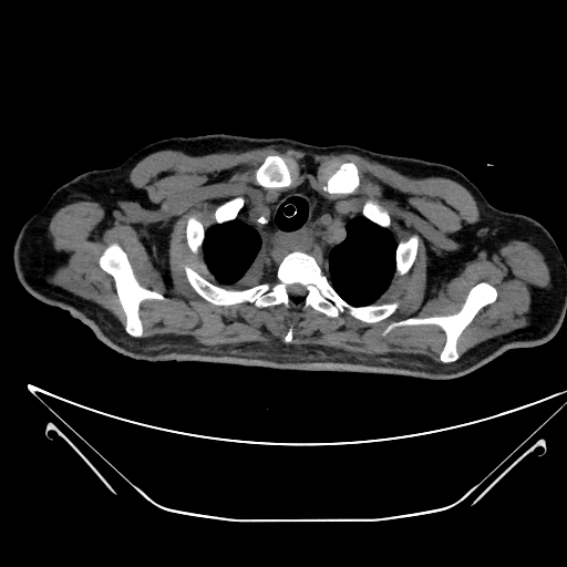 Aortic arch aneurysm (Radiopaedia 84109-99365 Axial non-contrast 41).jpg