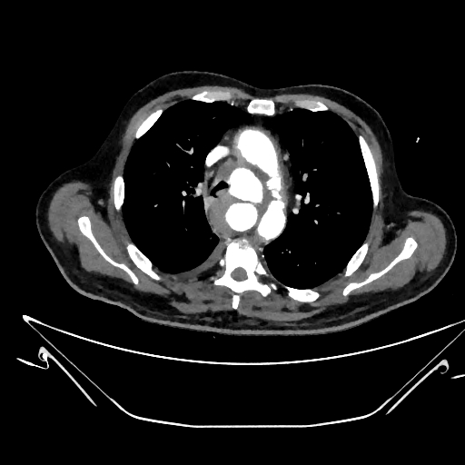 Aortic arch aneurysm (Radiopaedia 84109-99365 C 135).jpg