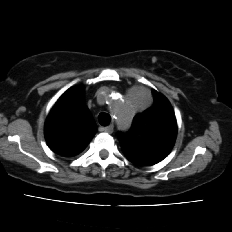 Aortic arch pseudoaneurysm (Radiopaedia 8534-9368 Axial non-contrast 15).jpg