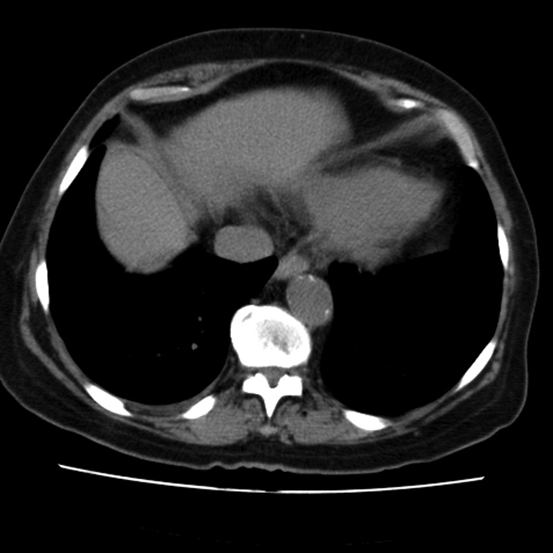 Aortic arch pseudoaneurysm (Radiopaedia 8534-9368 Axial non-contrast 57).jpg
