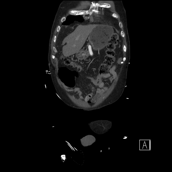 Aortic dissection (CTPA) (Radiopaedia 75506-86750 F 8).jpg
