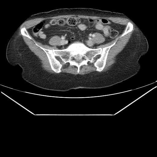 File:Aortic dissection (Radiopaedia 25350-25604 C 81).jpg