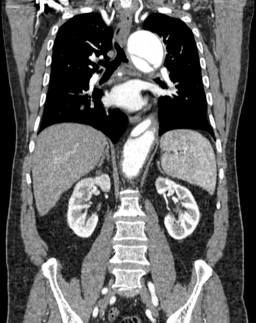 Aortic dissection (Radiopaedia 44411-48061 A 35).jpg