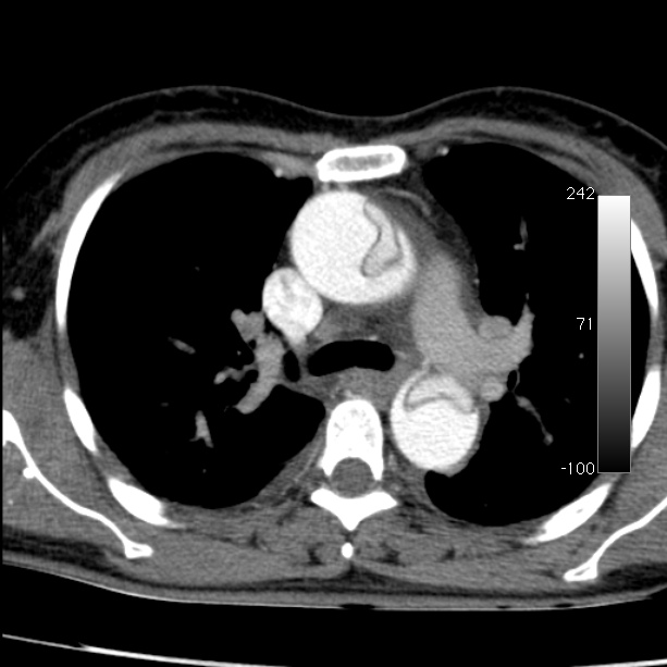 Aortic dissection - Stanford type A (Radiopaedia 29247-29659 A 29).jpg