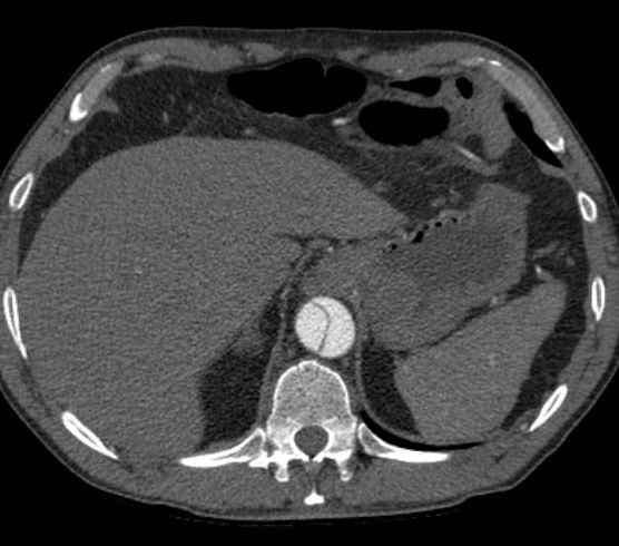 Aortic dissection - Stanford type B (Radiopaedia 73648-84437 A 107).jpg