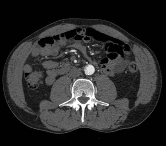 Aortic dissection - Stanford type B (Radiopaedia 73648-84437 A 172).jpg