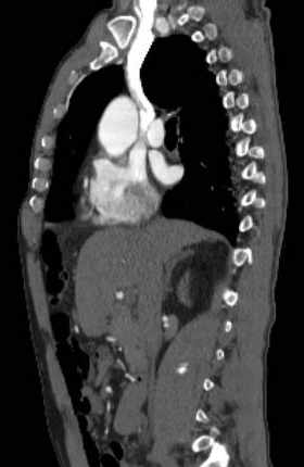 File:Aortic dissection - Stanford type B (Radiopaedia 73648-84437 C 92).jpg