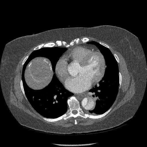 Aortic dissection - Stanford type B (Radiopaedia 88281-104910 A 56).jpg